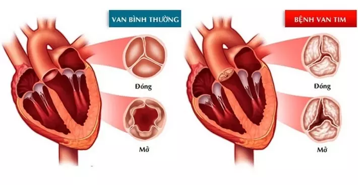 Khi nào hở van tim chuyển thành suy tim? Phòng ngừa thế nào?